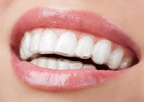 The Invisalign Revolution: Straightening Smiles in Luton