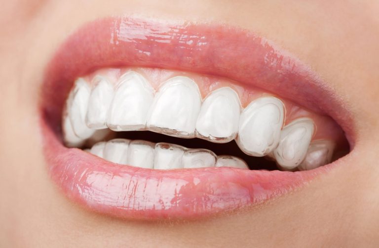 The Invisalign Revolution: Straightening Smiles in Luton