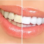 Harnessing Colour Theory for Optimal Teeth Whitening Results