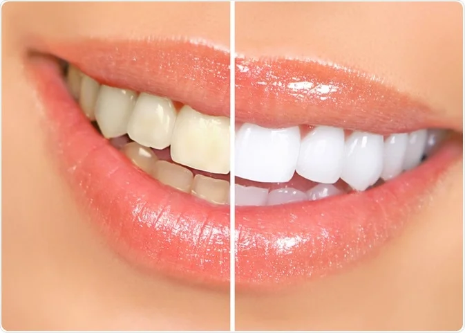 Harnessing Colour Theory for Optimal Teeth Whitening Results